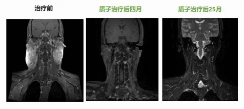 腫瘤放療“皇冠上的明珠”質(zhì)子治療，竟比普通放療更“省錢”