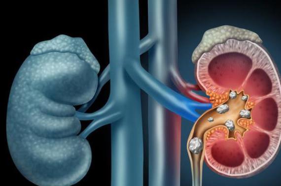 腎結(jié)石怎么能快速排出來 手術(shù)調(diào)整飲食治療