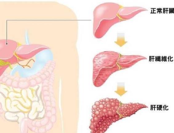 肝硬化可以治愈嗎 不可逆代償期五年生存率80%以上