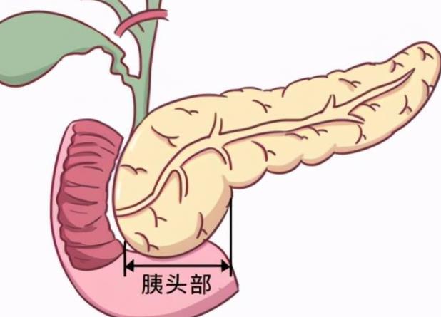 胰腺癌晚期能活多久 發(fā)病率低預(yù)后難3-6個月