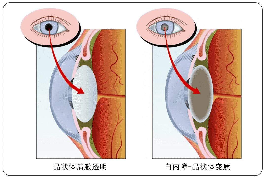 重慶高溫天氣下，普瑞眼科內(nèi)購會護(hù)眼福利來襲