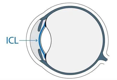 劉保松博士談ICL晶體植入?：同樣是近視手術(shù)，ICL為什么那么貴？