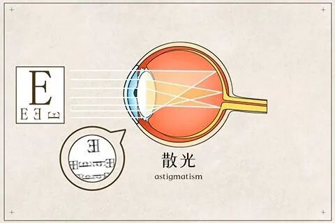 劉保松博士談ICL晶體植入?：近視+散光，選激光手術還是ICL?