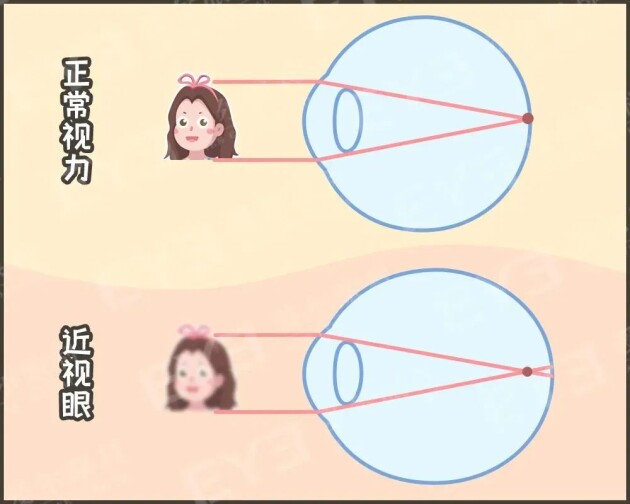 孩子戴上眼鏡度數(shù)會越來越高，確實如此嗎？——合肥愛爾眼科