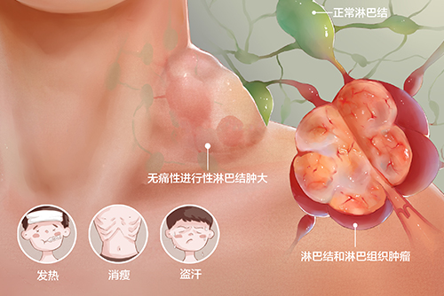  濟(jì)南血液病醫(yī)院科普：淋巴瘤患者的治療方法主要有哪些？