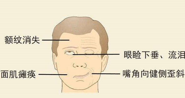 北京廣濟醫(yī)院怎么樣，治療面癱找對科室少走彎路