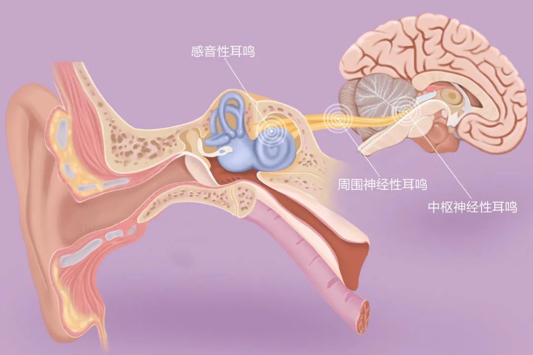 “嚶嚶嚶…”，成都民生耳鼻喉醫(yī)院提醒：耳鳴是身體的警報(bào)，須重視！