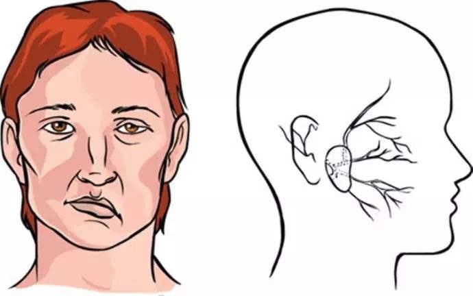 上海健橋醫(yī)院好不好，面癱的兩種常見癥狀和治療方法