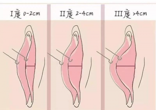 陰唇肥大又看不見(jiàn)，手術(shù)還有必要做嗎？在昆明這里告訴你!