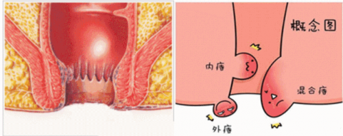 廣州東大肛醫(yī)院這樣區(qū)分內(nèi)痔外痔混合痔可信嗎？