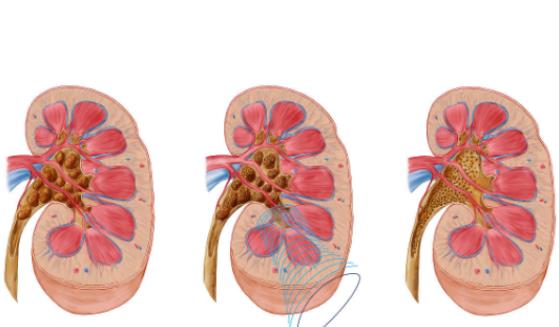 哪種腎結(jié)石好碎石 碎腎結(jié)石用什么碎