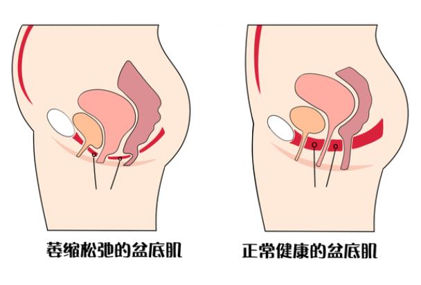 盆底肌受損影響生育嗎 盆底肌受損嚴重還能恢復嗎