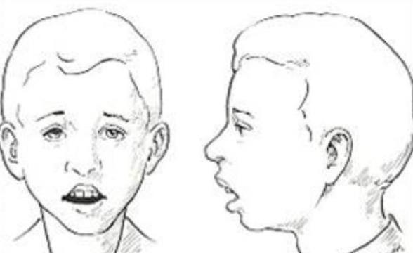 腺樣體面容如何矯正 飲食藥物手術調(diào)理改善