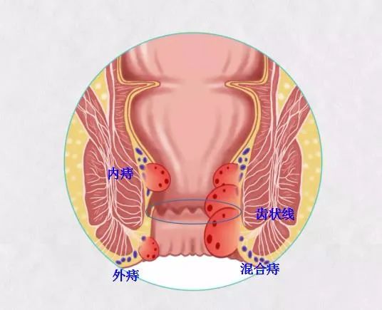 痔瘡之痛何以解，揚(yáng)州妙手肛腸醫(yī)院為痔瘡病友解決“難言之苦”