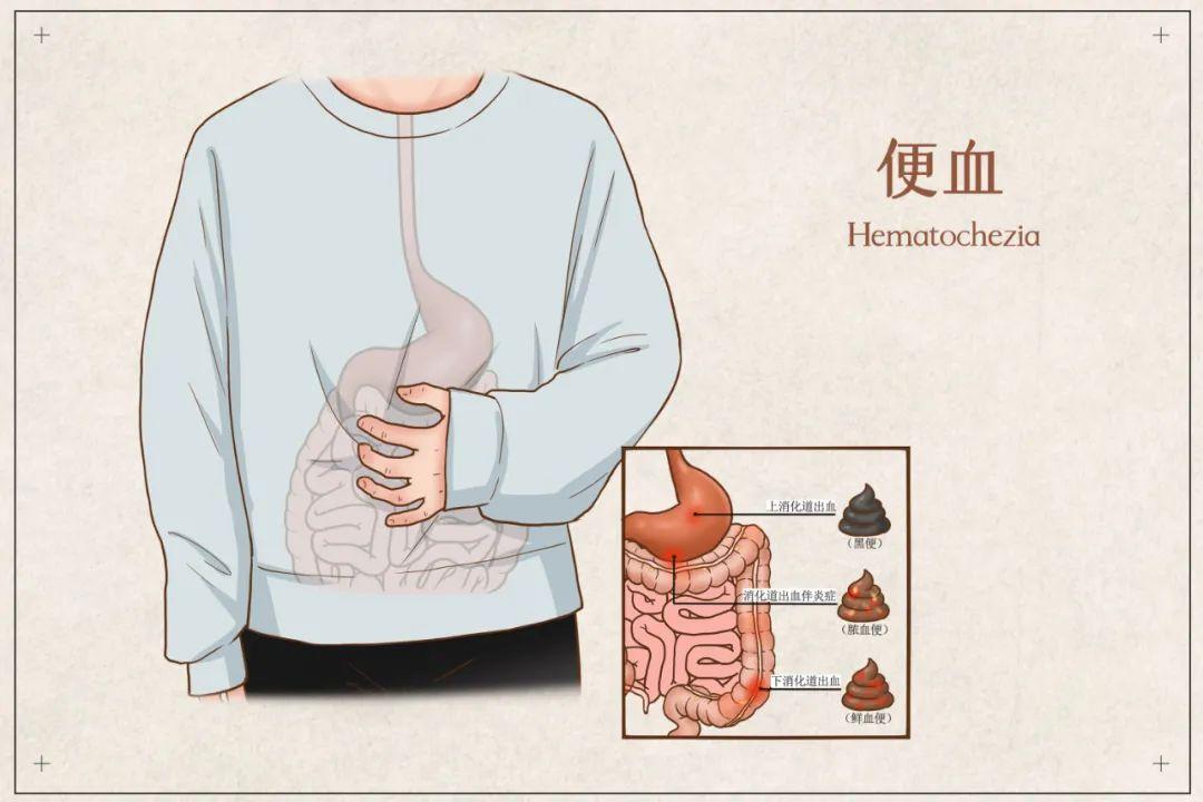 包頭東大肛腸專科醫(yī)院詳解大便出血咋回事