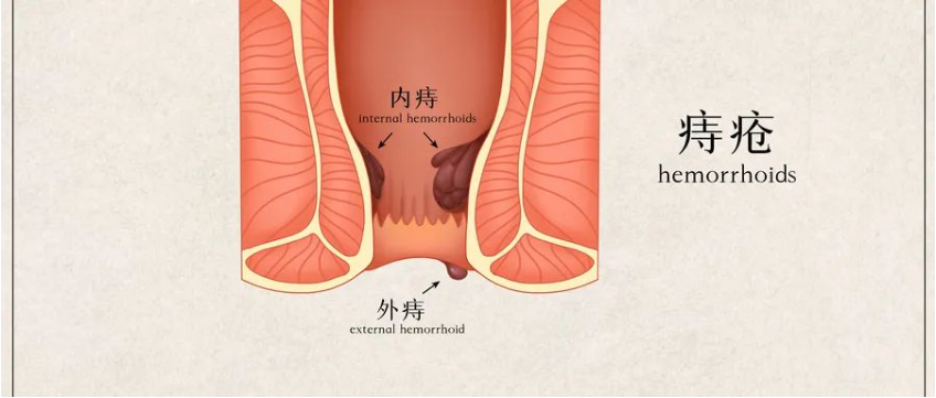 【北京豐益肛腸醫(yī)院】導(dǎo)致炎性外痔的主要原因有哪些？