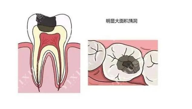 牙齒有洞不補會怎樣？牙齒有洞為什么一定要補？