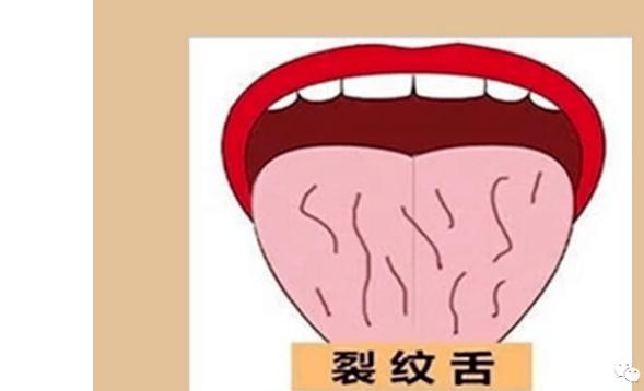 舌頭有裂紋是怎么回事？舌頭有裂紋要治療嗎？