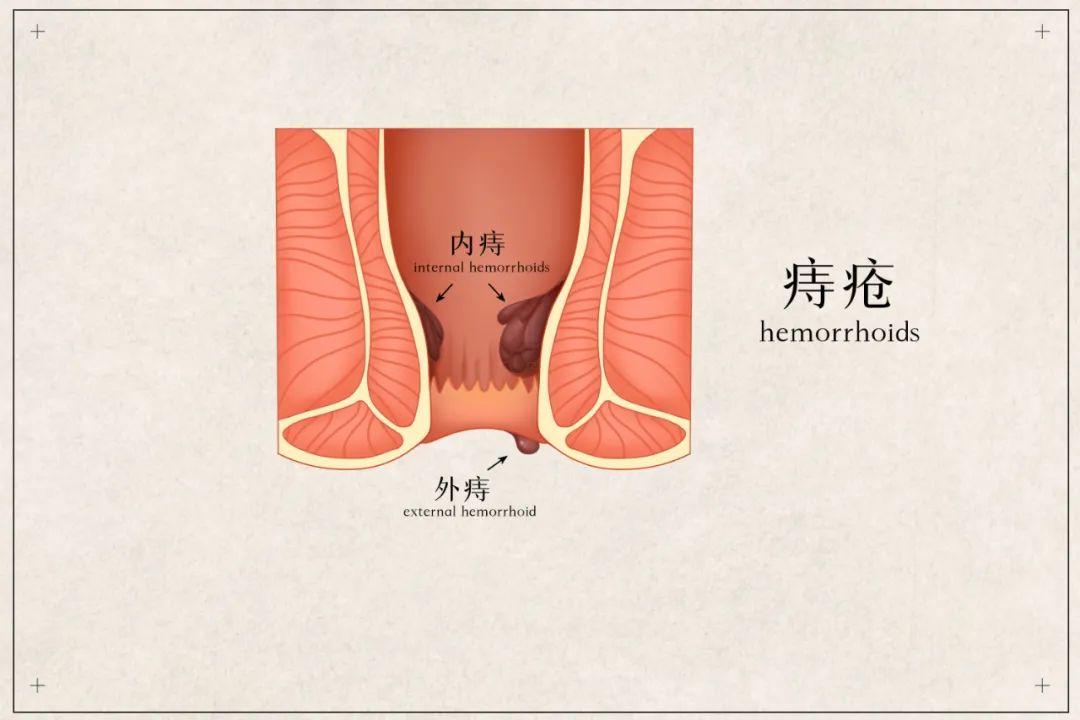 包頭東大肛腸?？漆t(yī)院詳解便血是怎么回事？