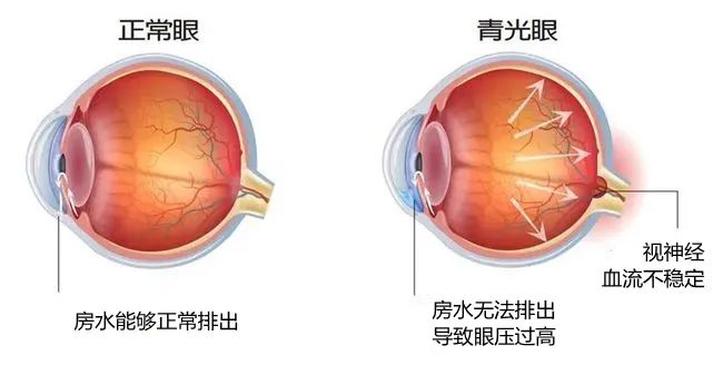 合肥愛(ài)爾眼科：白內(nèi)障跟青光眼有關(guān)系？