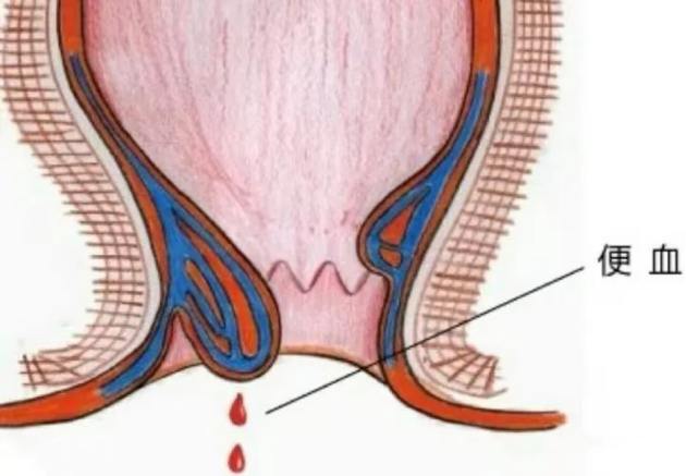 保定東大肛腸醫(yī)院丨肛腸疾病不都是痔瘡的“鍋”，這些疾病都不能忽視！