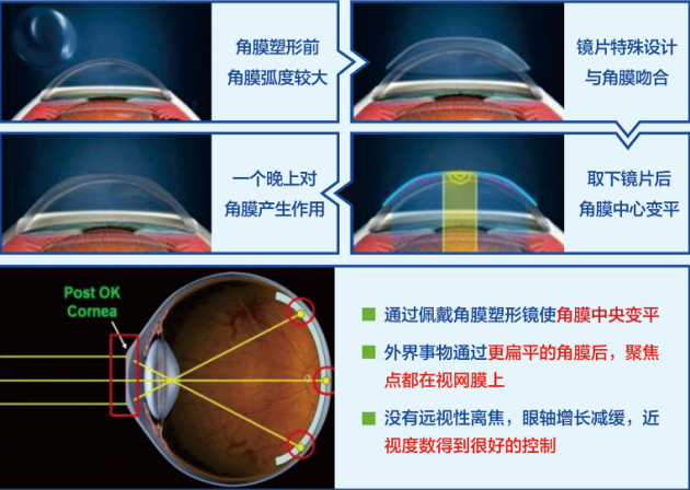 合肥愛爾眼科：角膜塑形鏡只要戴上就行？你想簡單了！