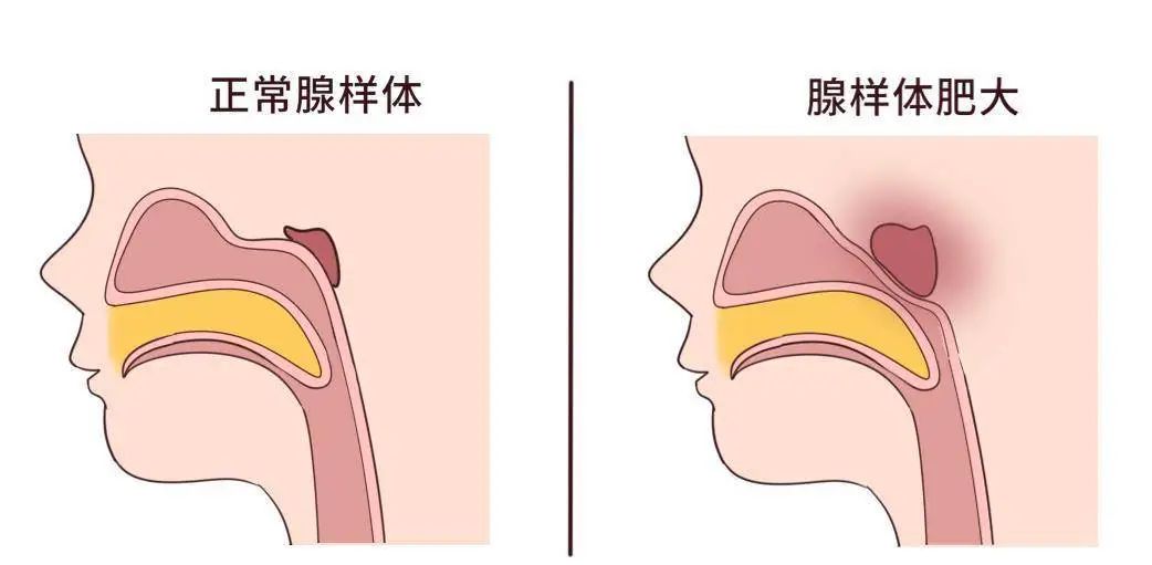 為什么現(xiàn)在患腺樣體肥大的孩子越來(lái)越多？聽(tīng)聽(tīng)成都民生耳鼻喉醫(yī)院怎么說(shuō)