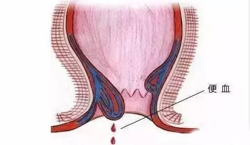 保定東大肛腸醫(yī)院丨肛腸疾病千萬別硬抗，這六種癥狀一定要去醫(yī)院！