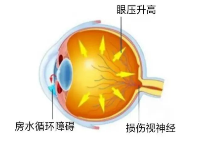 合肥愛(ài)爾眼科：青光眼嚴(yán)重嗎？它可能會(huì)致盲！