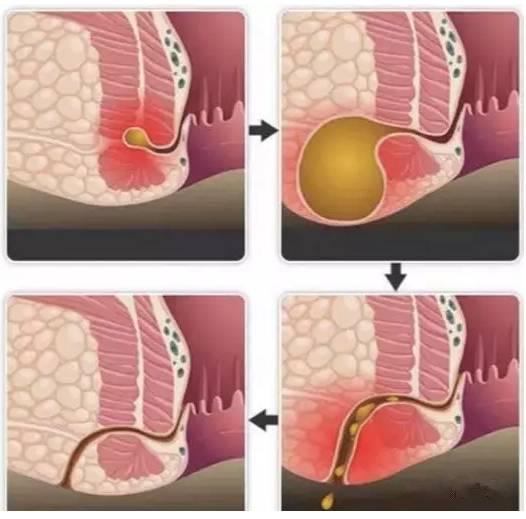 保定東大肛腸醫(yī)院看肛腸疾病怎么樣？這種高發(fā)的肛門疾病發(fā)病率僅次于痔瘡，卻幾乎無法自愈！