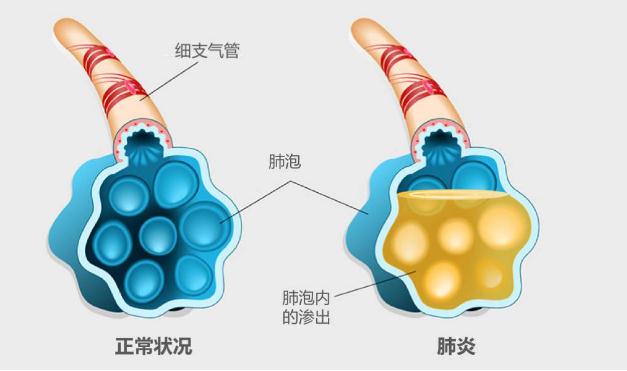 流感疫苗可以預(yù)防肺炎嗎 ？支原體肺炎更易侵襲小學(xué)生嗎？