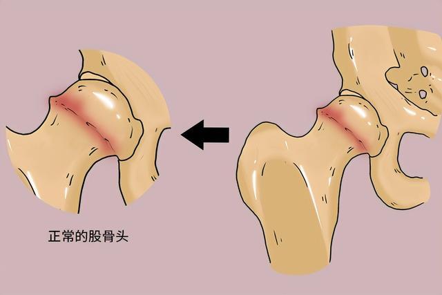 股骨頭壞死平常怎么養(yǎng)？專家推薦天然中成藥