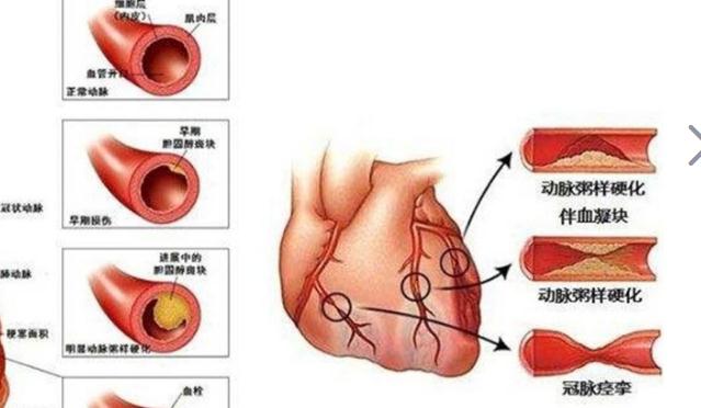 冠心病吃什么好？治療冠心病要多少錢？