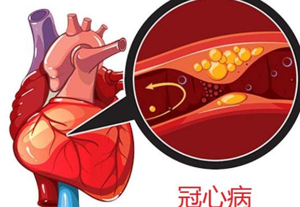 冠心病會引起頭暈嗎？冠心病會引起腳腫嗎？