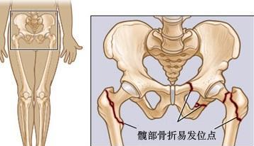 這些股骨頭壞死信號不容忽視，早期股骨頭壞死的保守治療