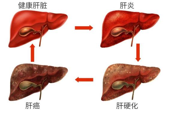 肝硬化可以治好嗎？肝硬化并發(fā)癥？