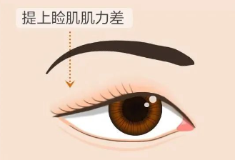 合肥愛爾專家科普：上瞼下垂＝眼皮松弛？其實(shí)真相是……