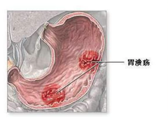 胃潰瘍是哪里疼痛 胃潰瘍好發(fā)于什么部位