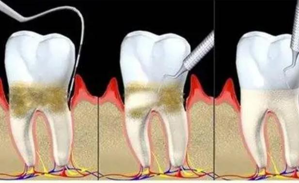 牙周炎跟腎虛有關(guān)系嗎？牙周炎跟上火有關(guān)系嗎？