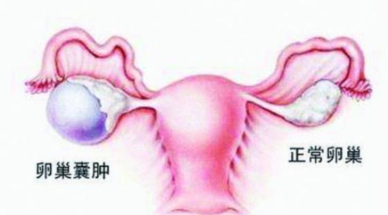 卵巢囊腫可以進(jìn)行房事嗎 得卵巢囊腫孩子還能要嗎