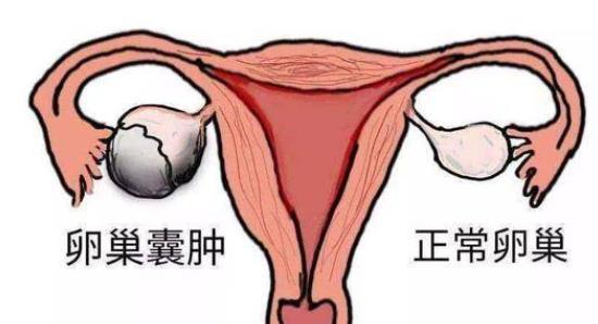 卵巢囊腫跟卵巢腫瘤有哪些區(qū)別 附件囊腫與卵巢囊腫的區(qū)別