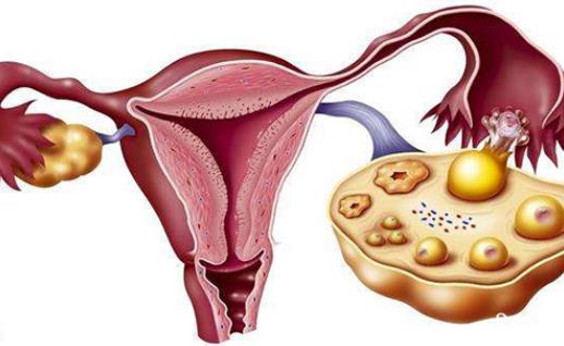 肥胖會導致多囊卵巢綜合征嗎 多囊卵巢綜合征有哪些危害