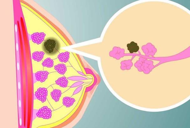 乳腺結(jié)節(jié)伴有疼痛是惡變嗎 乳腺增生所致應(yīng)及時(shí)就醫(yī)