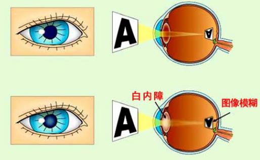 白內(nèi)障嚴(yán)重了會(huì)怎么樣 眩光色覺屈光改變眼睛敏感度視力下降