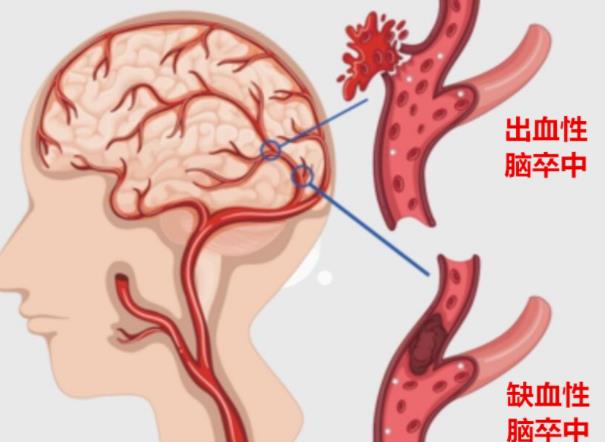 中風后能喝酒嗎 中風后注意什么