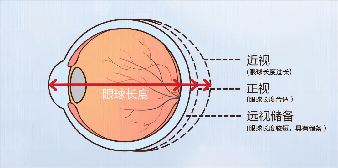 合肥愛爾眼科陳國府醫(yī)生深度揭秘：近視可逆嗎？