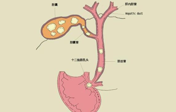 膽結石10mm怎么辦 膽結石10mm要開刀嗎