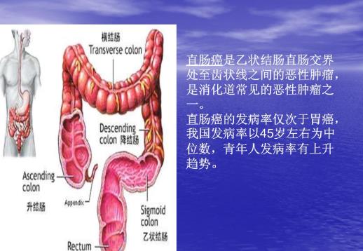 直腸癌早期能治好嗎 早期結(jié)直腸癌治愈率是多少