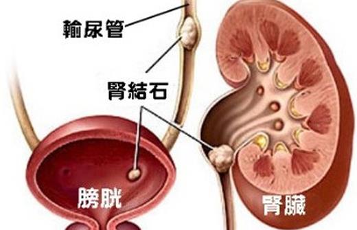 腎結(jié)石做什么手術好 腎結(jié)石發(fā)燒吃什么藥