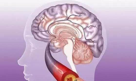 腦梗病人能治愈嗎 腦梗怎么辦